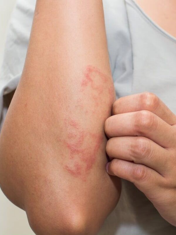 Skin Allergy Treatment
